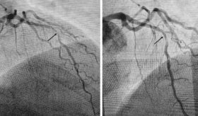 Paciente diabético con isquemia transitoria no diagnosticable por ECG desarrolla oclusión coronaria