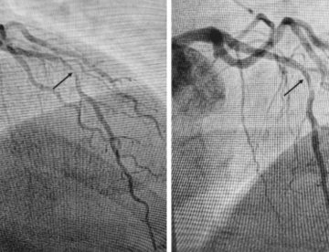 Paciente diabético con isquemia transitoria no diagnosticable por ECG desarrolla oclusión coronaria
