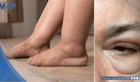 ¿Hinchazón en piernas o párpados? Podría ser edema, la primera alerta de falla cardíaca, renal o hepática