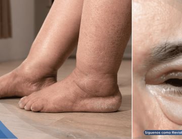 ¿Hinchazón en piernas o párpados? Podría ser edema, la primera alerta de falla cardíaca, renal o hepática