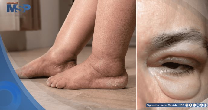 ¿Hinchazón en piernas o párpados? Podría ser edema, la primera alerta de falla cardíaca, renal o hepática