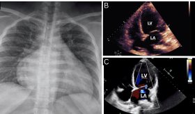 Disfunción multiorgánica secundaria a miocardiopatía periparto en mujer puertorriqueña previamente sana