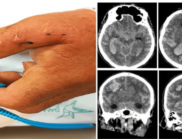 Hombre de 80 años presenta hemorragia intracerebral tras mordedura de serpiente Bothrops asper