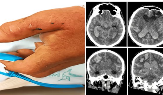 Hombre de 80 años presenta hemorragia intracerebral tras mordedura de serpiente Bothrops asper