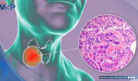 Carcinoma Papilar Tiroideo: epidemiología, factores de riesgo y manejo basado en evidencia