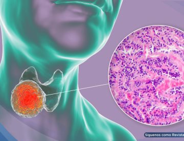 Carcinoma Papilar Tiroideo: epidemiología, factores de riesgo y manejo basado en evidencia
