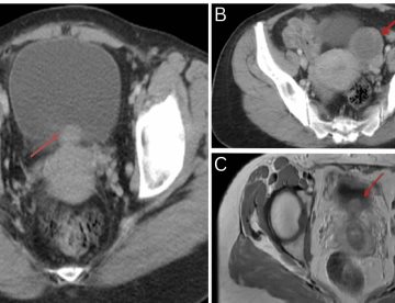 Síntomas urinarios persistentes sin patrón menstrual revelaron endometriosis vesical en mujer de 37 años