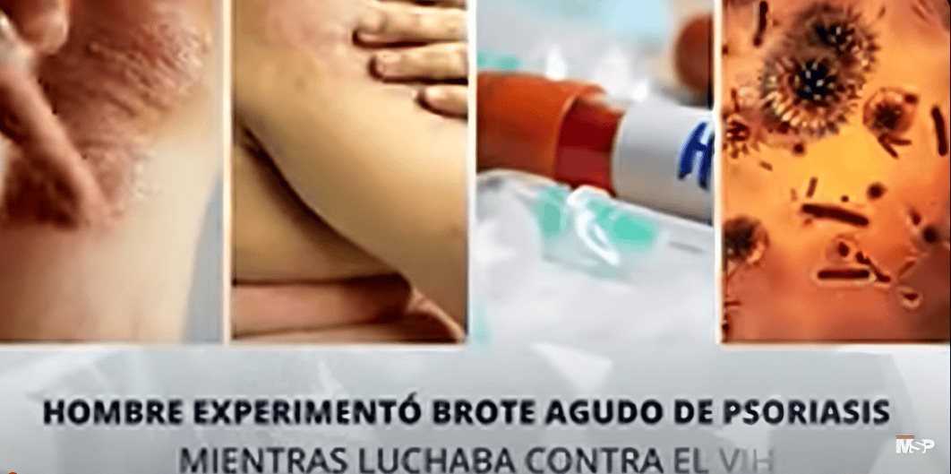 Hombre experimentó brote agudo de psoriasis mientras luchaba contra VIH