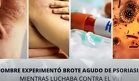 Hombre experimentó brote agudo de psoriasis mientras luchaba contra VIH