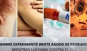 Hombre experimentó brote agudo de psoriasis mientras luchaba contra VIH