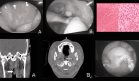 Descubren schwannoma nasofaríngeo en paciente con anosmia y cefalea crónica que simulaba rinosinusitis