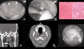 Descubren schwannoma nasofaríngeo en paciente con anosmia y cefalea crónica que simulaba rinosinusitis