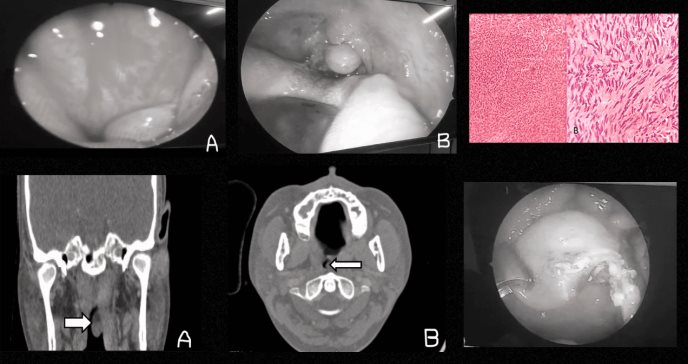 Descubren schwannoma nasofaríngeo en paciente con anosmia y cefalea crónica que simulaba rinosinusitis