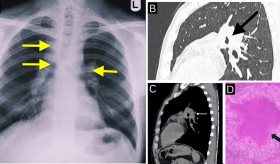 Tos, fiebre leve y pérdida de peso como presentación de tuberculosis mediastínica en mujer de 55 años