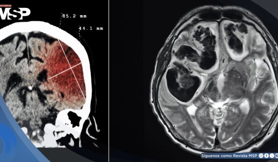 ¿Infarto o sangrado cerebral? Así se diferencian los tipos de accidente cerebrovascular