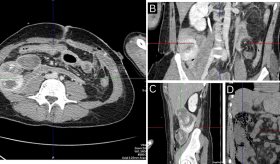 Manifestación de enfermedad de Crohn tras trauma abdominal por herida de bala en hombre de 34 años