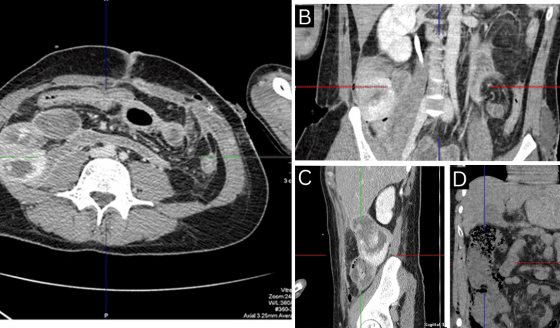 Manifestación de enfermedad de Crohn tras trauma abdominal por herida de bala en hombre de 34 años