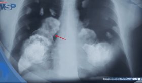 Por primera vez demuestran que la contaminación atmosférica provoca cáncer de pulmón y daño en el ADN