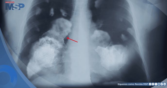 Por primera vez demuestran que la contaminación atmosférica provoca cáncer de pulmón y daño en el ADN