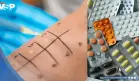 Reacciones alérgicas a medicamentos: ¿Cuáles son las más frecuentes y cómo actuar?  