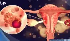 ¿Cansancio extremo durante la menstruación?: Podría ser SOP, trastorno disfórico premenstrual o anemia