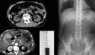Paciente con líquido abdominal negro evoluciona a fallo multiorgánico por pancreatitis aguda grave