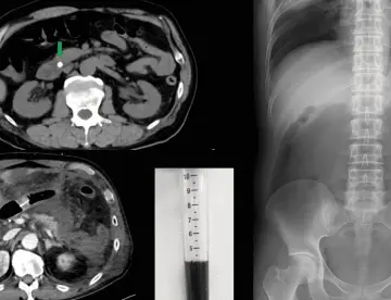 Paciente con líquido abdominal negro evoluciona a fallo multiorgánico por pancreatitis aguda grave
