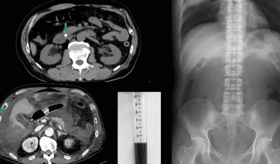 Dolor abdominal e insuficiencia respiratoria revelan pancreatitis aguda con ascitis negra y necrosis