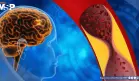 Fármaco para psoriasis muestra potencial como primer tratamiento efectivo contra la demencia vascular