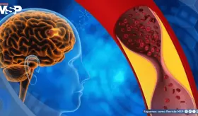 Fármaco para psoriasis muestra potencial como primer tratamiento efectivo contra la demencia vascular