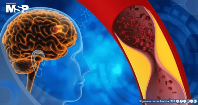 Fármaco para psoriasis muestra potencial como primer tratamiento efectivo contra la demencia vascular