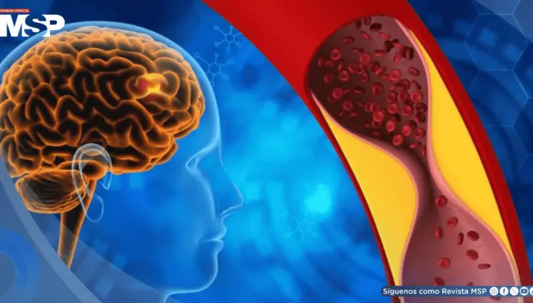 Fármaco para psoriasis muestra potencial como primer tratamiento efectivo contra la demencia vascular
