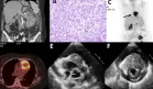Carcinoma renal con metástasis cardíaca en mujer de 52 años con disnea súbita y taponamiento cardiaco