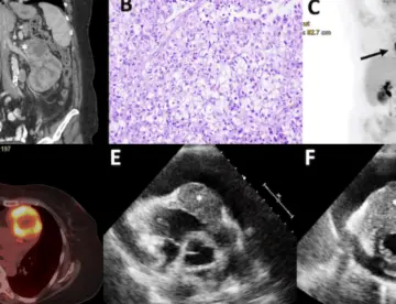 Carcinoma renal con metástasis cardíaca en mujer de 52 años con disnea súbita y taponamiento cardiaco
