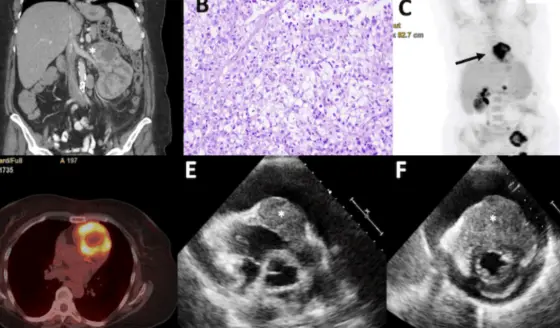 Carcinoma renal con metástasis cardíaca en mujer de 52 años con disnea súbita y taponamiento cardiaco