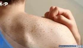 Estados Unidos registra su peor brote de sarampión en más de 30 años con tres muertes confirmadas