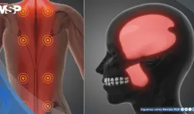 ¿Dolor que no desaparece con el descanso? Podría ser síndrome de dolor miofascial