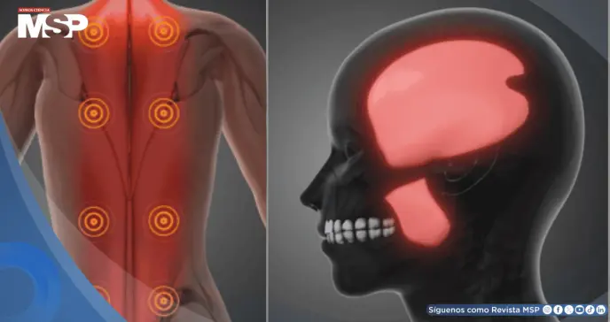 ¿Dolor que no desaparece con el descanso? Podría ser síndrome de dolor miofascial