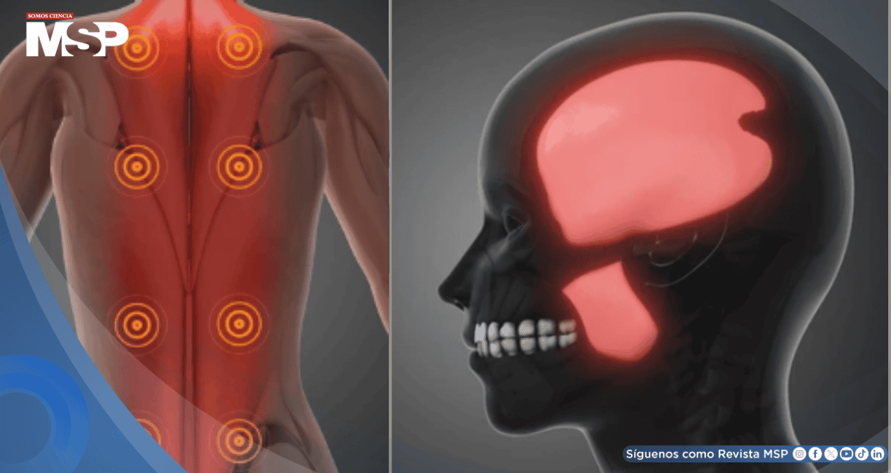 ¿Dolor que no desaparece con el descanso? Podría ser síndrome de dolor miofascial