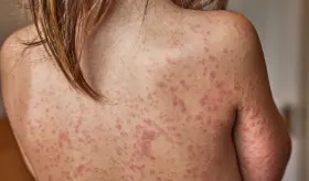 EEUU atraviesa su peor epidemia de sarampión, según universidad Johns Hopkins