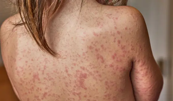 EEUU atraviesa su peor epidemia de sarampión, según universidad Johns Hopkins