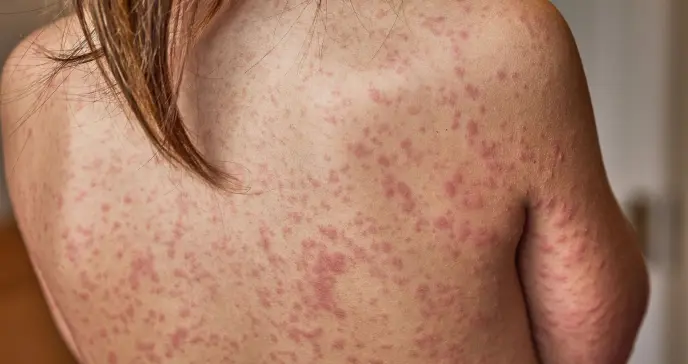 EEUU atraviesa su peor epidemia de sarampión, según universidad Johns Hopkins