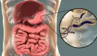 Helicobacter pylori causaría 12 millones de cánceres gástricos, pero el 75% serían evitables: Estudio