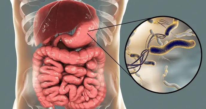 Helicobacter pylori causaría 12 millones de cánceres gástricos, pero el 75% serían evitables: Estudio