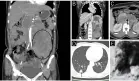 Mujer con dolor lumbar es diagnosticada con leiomiosarcoma renal con invasión tumoral vascular