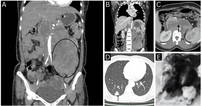Mujer con dolor lumbar es diagnosticada con leiomiosarcoma renal con invasión tumoral vascular