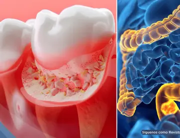 La periodontitis afecta al 69,5% de pacientes con cáncer colorrectal y aceleraría el desarrollo tumoral