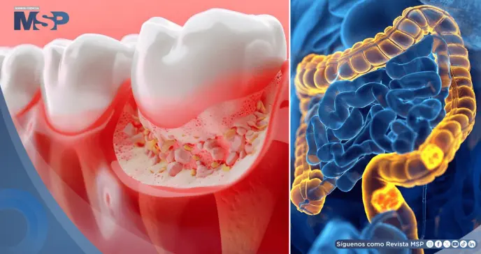 La periodontitis afecta al 69,5% de pacientes con cáncer colorrectal y aceleraría el desarrollo tumoral
