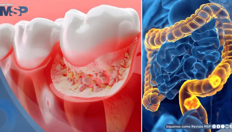 La periodontitis afecta al 69,5% de pacientes con cáncer colorrectal y aceleraría el desarrollo tumoral