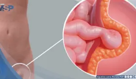 Dolor, bulto y molestias al esforzarse: Síntomas clave de una hernia que no debe ignorar